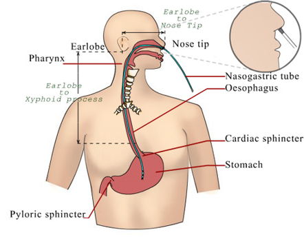 KE diet tube feeding diet1