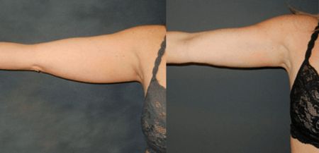 underarm-fat-removal