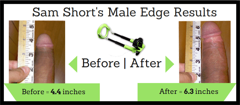 Male-Edge-Results_Before And AFter