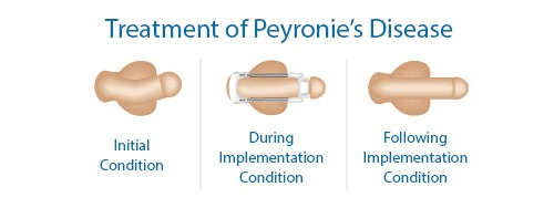 Peyronies-disease-treatment-using-male_edge