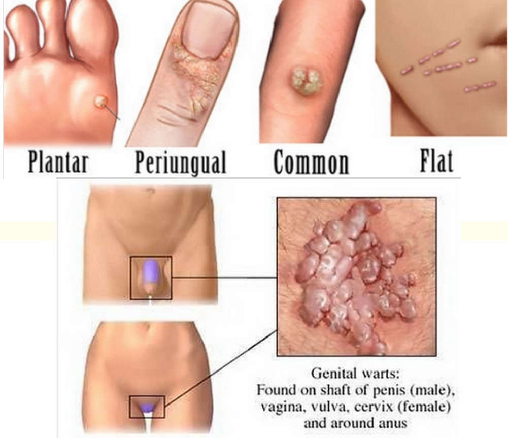 common-area-of-warts-and-how-to-remove-with-wartrol